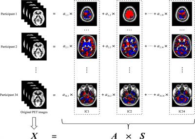 The Detection of Invisible Abnormal Metabolism in the FDG-PET Images of Patients With Anti-LGI1 Encephalitis by Machine Learning